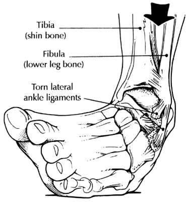 Image courtesy of The American Board of Lower Extremity Surgery (2015)